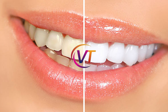 Teeth Whitening Services