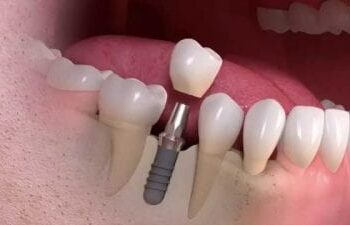 How is a dental implant installed?