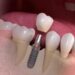 How is a dental implant installed?